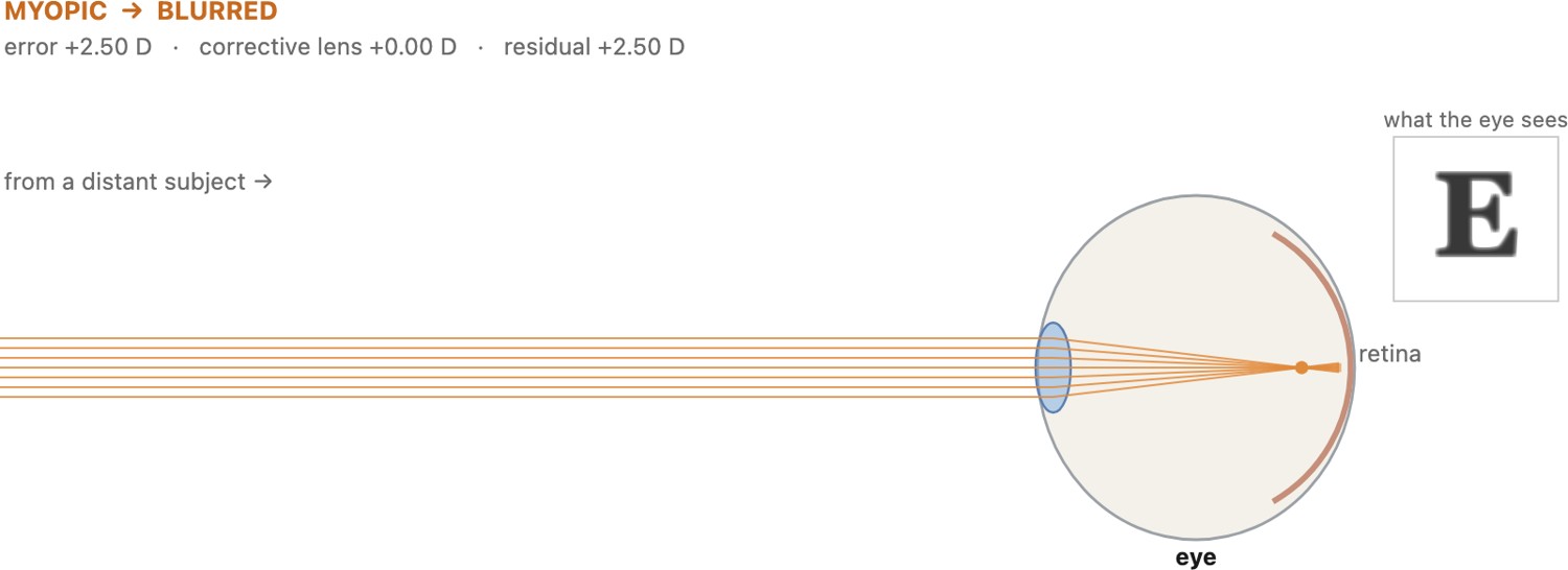 fig-refractive-errors